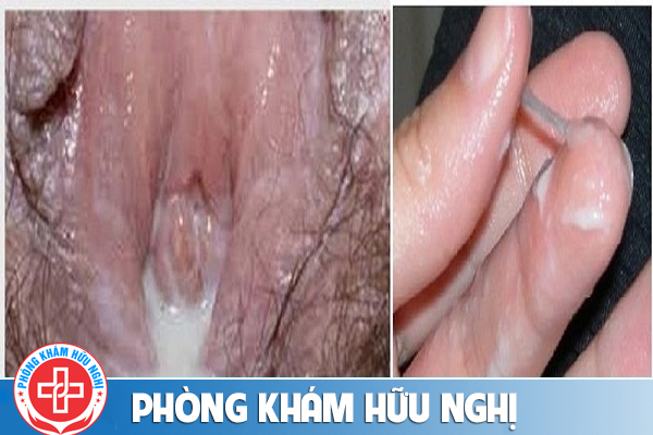 bieu-hien-benh-lau-nu