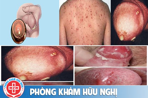 trieu-chung-benh-lau-o-nam-gioi-la-gi