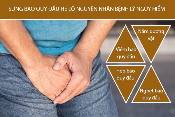 Sưng bao quy đầu hé lộ nguyên nhân bệnh lý nguy hiểm